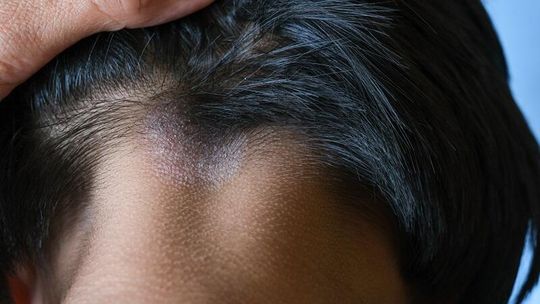 Łuski na skórze głowy – jak skutecznie je usuwać bez podrażnień?